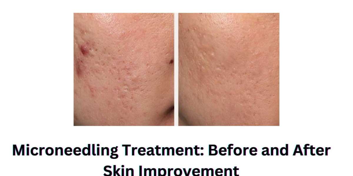 Microneedling Treatment: Before and After Skin Improvement