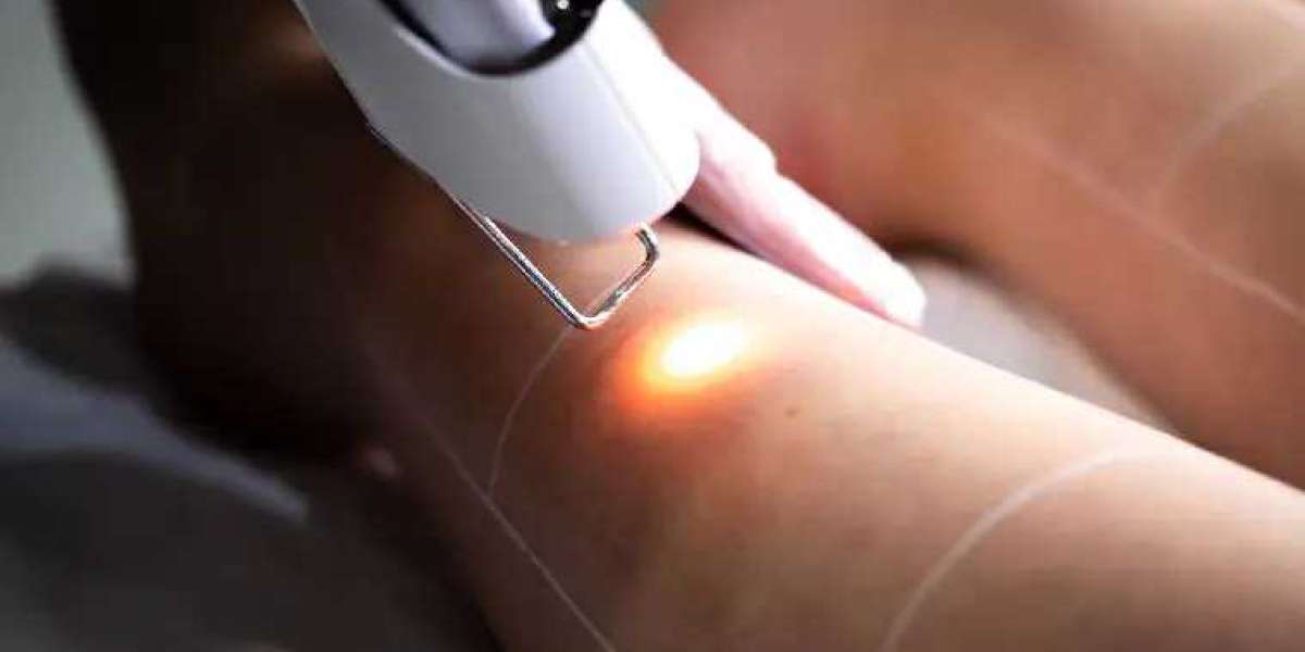 How Long Does Laser Hair Removal Last? All You Need to Know