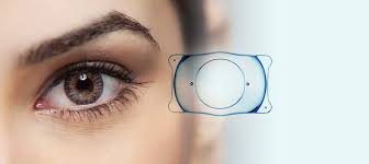 Benefits of ICL Lens Surgery