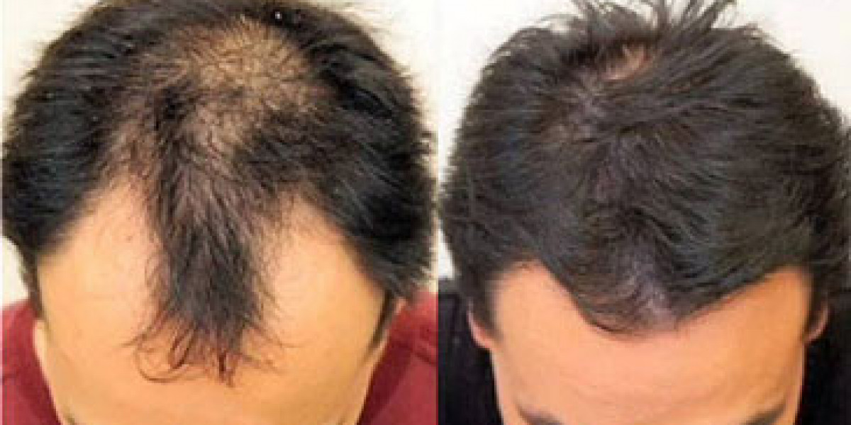 Best Hair Transplant Method: FUE, FUT & Latest Tech