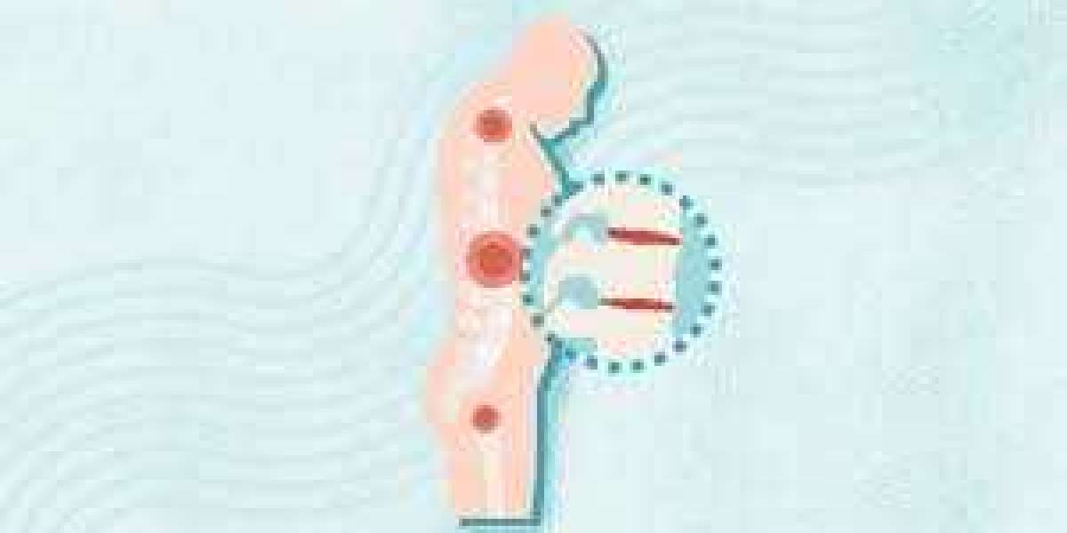 Relieve Spondylitis Discomfort with Celebrex 200mg