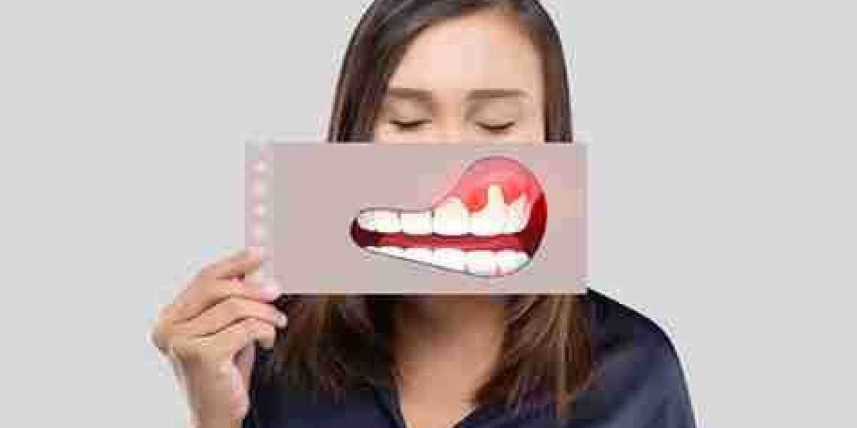 Why Gingivitis Develops and How to Stop It Early